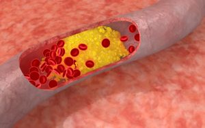 Giảm cholesterol trong máu